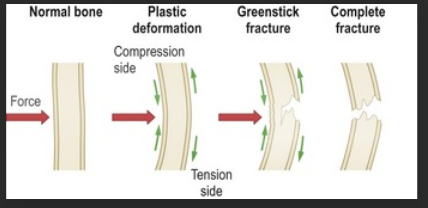 <ol><li><p><span style="color: rgb(60, 75, 214);"><strong>greenstick</strong>: incomplete fracture</span></p></li><li><p><span style="color: rgb(247, 128, 128);"><strong>plastic deformation</strong>: bone <strong>bent no more than 45</strong> degrees and <strong>doesnt break</strong></span></p></li><li><p><span style="color: rgb(32, 137, 123);"><strong>buckle</strong></span><span style="color: rgb(23, 26, 26);"><strong> </strong>(torus): one side</span><span style="color: rgb(32, 137, 123);"> <strong>bulges</strong></span><strong> </strong>(like dent)</p></li></ol><p></p>
