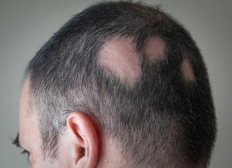 <p>An autoimmune condition that causes patchy hair loss.</p>