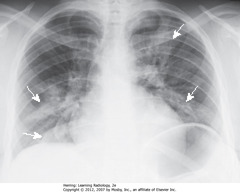 <p>infiltrates are patchy and involves multiple areas of the lung</p>