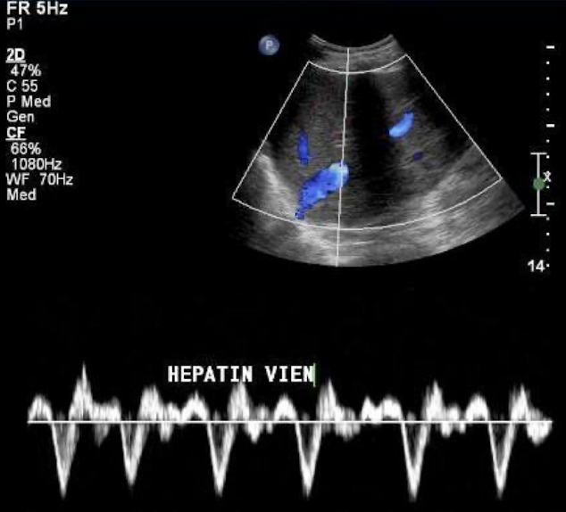 <ul><li><p>hepatofugal (blue)</p></li><li><p>phasic bidirectional flow—indicated by “to-fro” sign </p><ul><li><p>LHV more pulsatile due to proximity to heart (common)</p></li></ul></li></ul><p></p>