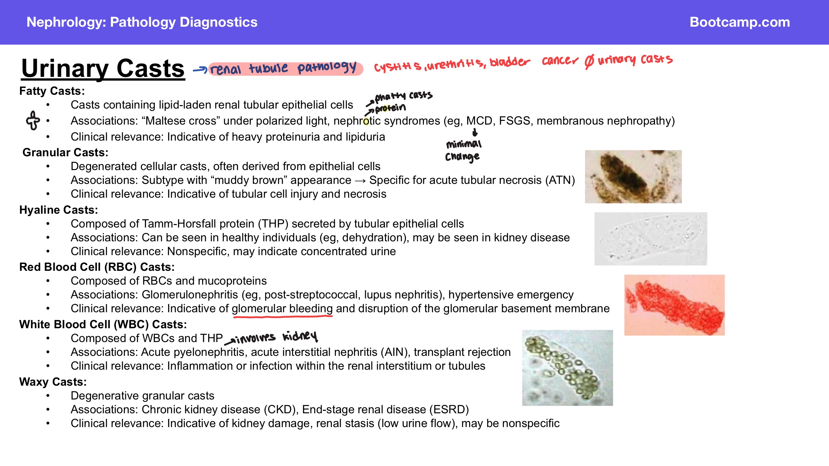 <p>Answer: Nephrotic syndromes such as minimal change disease, focal segmental glomerulosclerosis, and membranous nephropathy.</p><p>Extra Information:</p><ul><li><p>Fatty casts indicate heavy proteinuria and lipiduria.</p></li></ul><p></p>