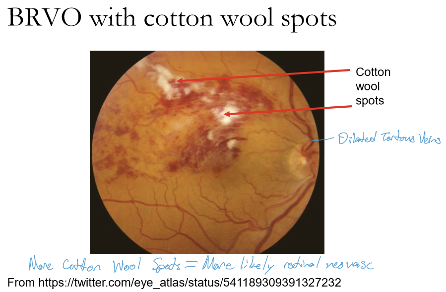 <p>BRVO shows changes limited to the sector drained by the affected vein, including:</p><ul><li><p>Dilated, tortuous veins</p></li><li><p>Flame-shaped hemorrhages (primary)</p></li><li><p>Dot-blot hemorrhages</p></li><li><p>Sectoral distribution matching the occluded branch</p></li></ul><p></p>