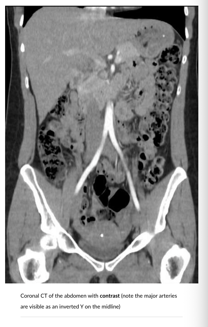 <p>Air: Black </p><p>Bone: White</p><p>Soft Tissue: Grey</p><p>BV: White like Bone </p>