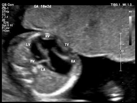 <p>displacement of leaflets of tricuspid valve into rt ventricle </p><ul><li><p>regurgitation </p></li><li><p>causing increase in size of right atrium</p></li></ul><p></p>