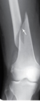 <p>produced by twisting stresses that spread along length of bone</p>