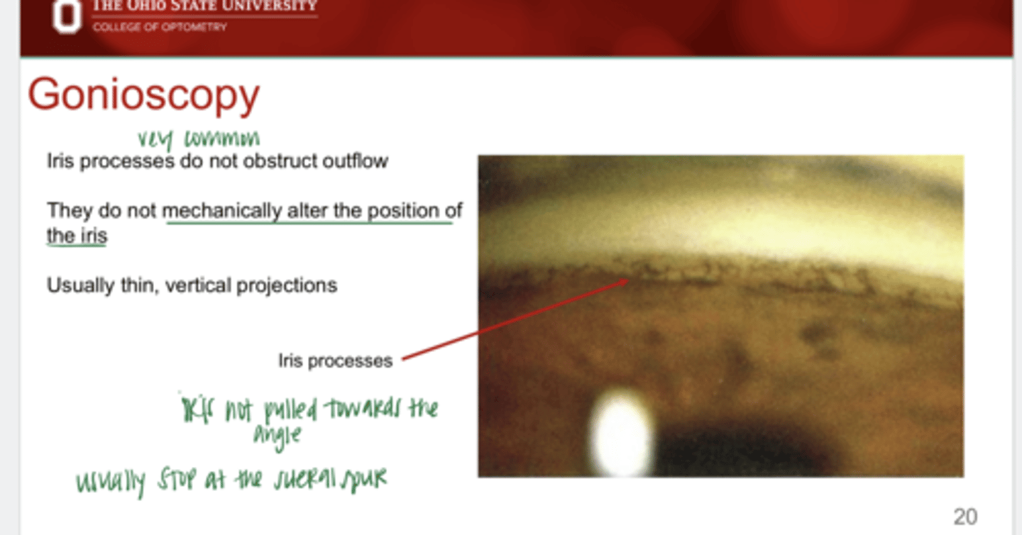 <p>Iris processes usually stop at what angle structure?</p>