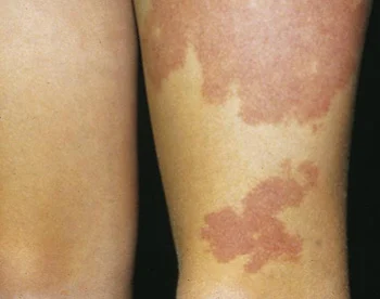 <p>Capillary hemangioma (nervous flammeus) (vascular lesions) </p>