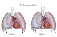 <p>MEDICAL EMERGENCY ... causes tracheal deviation</p>