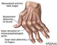 <p>sự/dị tật, biến dạng</p>