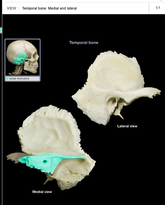 <p>Petrous part of temporal bone</p>