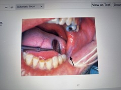 <p>Form of hyperkeratosis caused by chronic rubbing or friction against an oral mucosal. Resembles a callus on skin. </p><p>TX: identify and eliminate cause of lesion</p><p>CAN LOOK LIKE IDIOPATHIC LEUKOPLAKIA!!!!</p>