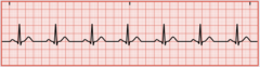 <p>Heart rate is 60 to 100/min</p>