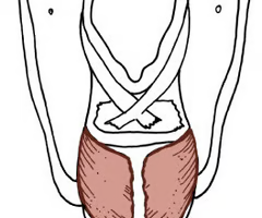 <p><span>INTRINSIC ABDUCTOR</span><br><br><span>origin: posterior cricoid lamina</span><br><br><span>insertion: posterior aspect of muscular process of arytenoid cartilage</span><br><br><span>innervation: CN X, RLN</span><br><br><span>function: rocks arytenoid cartilage laterally, abductor; medial part acts to stabilize and fix arytenoid</span></p><p></p>