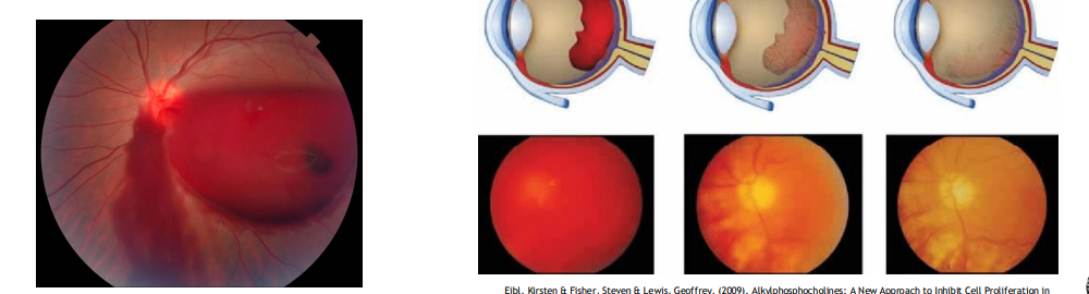 <ul><li><p>PVD → Tears blood vessel → Vitreous hemorrhage</p></li><li><p>Traumatic</p></li><li><p>Associated with retinal tears</p></li></ul><p></p>