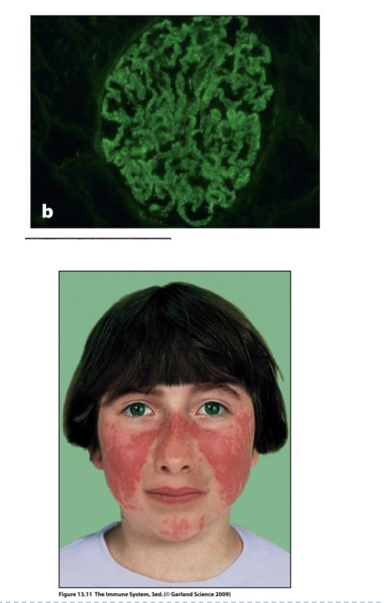 <p> Green = anti-Ig Ab shows Auto-antibodies in green, deposited on basement membrane of kidney section.</p><p><strong> Butterfly shaped skin rash (erythema) can appear on face due to immune complexes in the skin</strong></p>
