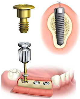 <p><span>a small screw placed over a dental implant to protect it during the healing phase (two-stage) before suturing</span></p><p><span style="color: rgb(255, 0, 0);">• purpose: </span><span>to prevent bone from growing between the screw and the implant</span></p><p><span>• in the second stage of two- stage surgery, the cover screw is removed and replaced with a healing abutment</span></p>
