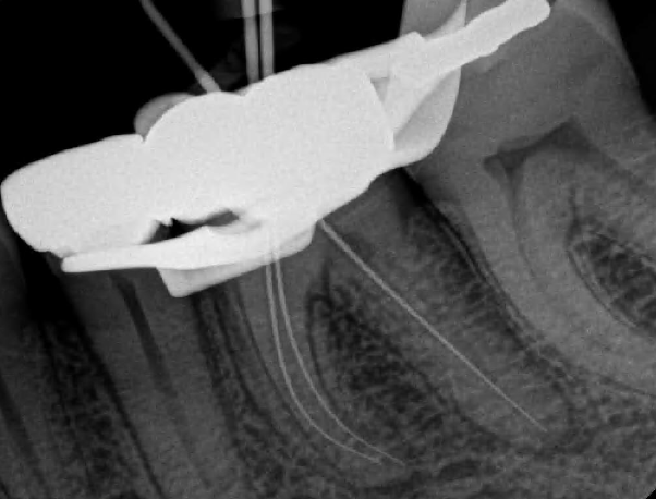 <p>What tool can you utilize to separate the MB and ML canals?</p>
