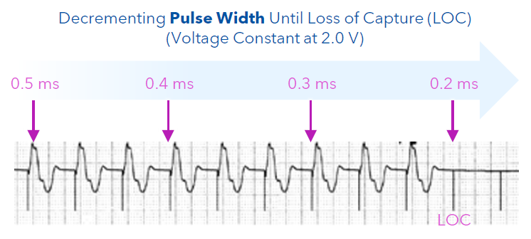 <p>With this approach, the amplitude (voltage) remains constant, but the pulse width is shortened until loss of capture occurs. The threshold is the shortest pulse width duration that consistently captured the myocardium.</p>