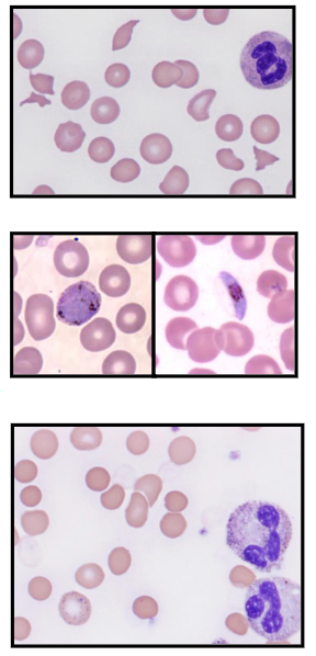 <p>SEVERE BACTERIAL SEPSIS:</p><p>- Dissem. intravascular coagulation; fragmented red cells (MAHA)</p><p>.</p><p>MALARIA (plasmodium sp.)</p><p>- P.vivax, falciparum, ovale, malarie</p><p>- Trophozoites; schizonts; gametocytes</p><p>.</p><p>CLOSTRIDIUM WELCHII:</p><p>- microspherocytes in PB film</p><p>.</p><ul><li><p>order of images is the order of the subheadings</p></li></ul><p></p>