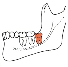 <p>ID the angulation classification of the impacted 3rd molar:</p>