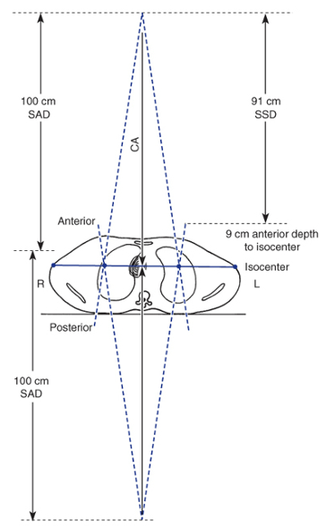 <p>Source-Axis Distance (SAD) </p><ul><li><p>Also, target-axis distance </p></li><li><p>The SAD for modern linear accelerators is 100cm </p></li><li><p>the field size is defined is inside the patient at the isocenter distance</p></li></ul><p></p>
