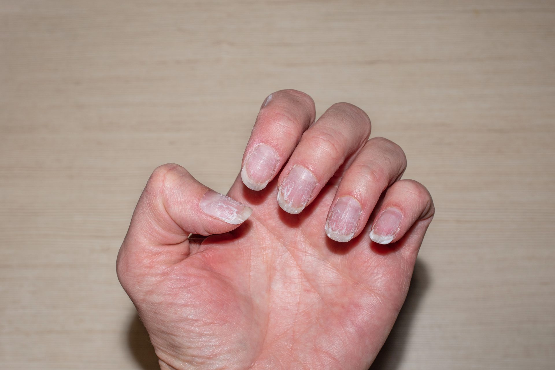 <p>what nail condition is this?</p>