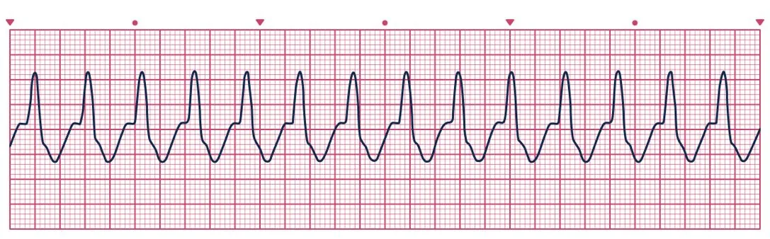 <p><span>You see this ECG rhythm strip on placement during a cardiac arrest - what rhythm is it?</span></p>