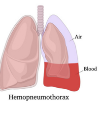 <p>air and blood in the pleural space </p><p>will be treated with chest tube</p>