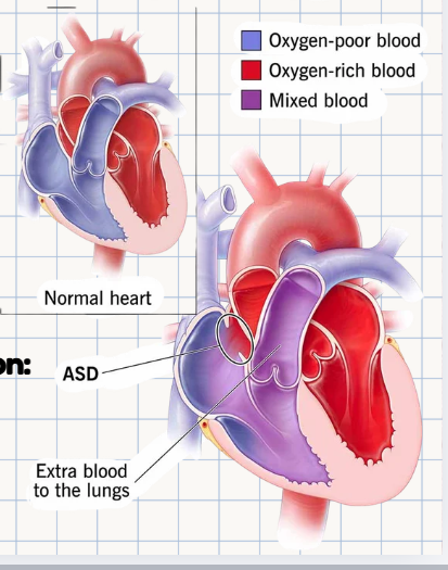 <p>A pathological problem where there is an <strong>opening or hole within the interatrial septum</strong>, with shunting occurring in the direction of the pressure gradient between the two atria.</p>