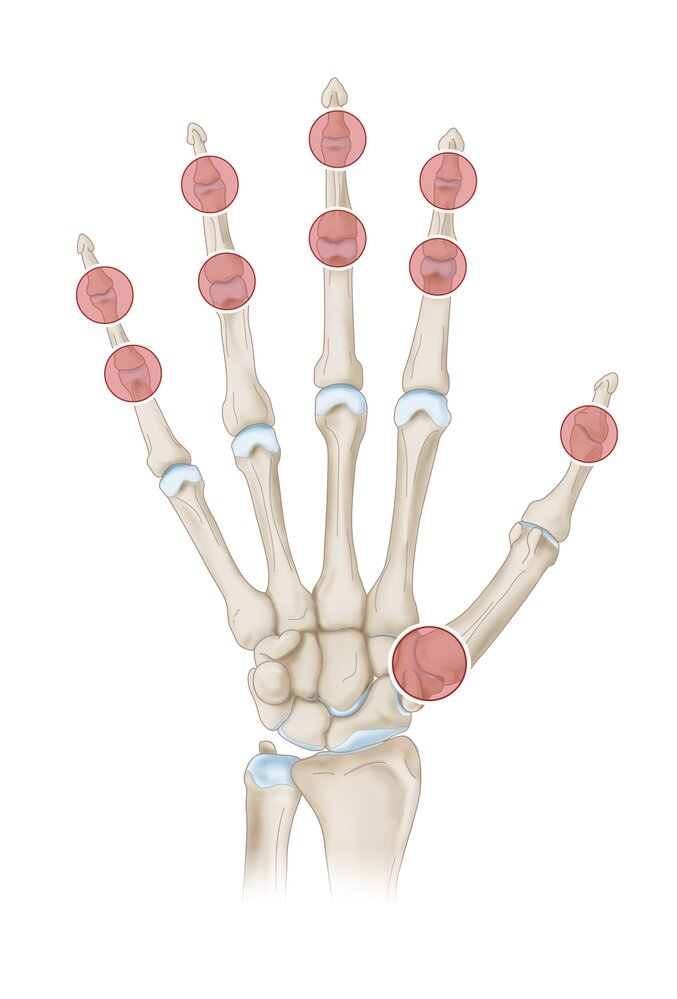 <p>Pain with movement</p><ul><li><p>Relief at rest</p></li></ul><p>Joint stiffness + decreased ROM</p><ul><li><p>Early: In morning</p></li><li><p>Advanced: Throughout the day</p></li></ul><p>Asymmetric joint involvement</p><p>Crepitus</p><p>Knee:</p><ul><li><p>Locking/crepitus</p></li><li><p>Bowed legs</p></li><li><p>Joint swelling with activity</p></li></ul><p>Hip: Pain in groin</p><p>Hands:</p><ul><li><p>Heberden’s Nodes: Pain + nodes on dorsal DIP</p></li><li><p>Bouchard Nodes: Pain + nodes on dorsal PIP</p></li><li><p>Rhizarthrosis: 1st CMC joint</p></li></ul><p></p>