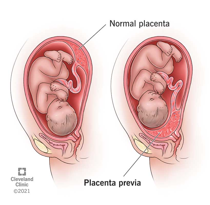 <p>a placenta implanted over the cervical region of the uterus, blocking the entrance to the birth canal </p>