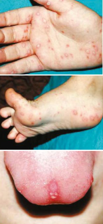 <ul><li><p>+ssRNA virus, picornaviridae (N*)</p></li><li><p><u>fever</u>, <u>sore throat</u>, oral cavity <u>lesion</u> (buccal mucosa + tongue), palms + soles</p></li><li><p>no vaccine prevention</p></li></ul><p></p>