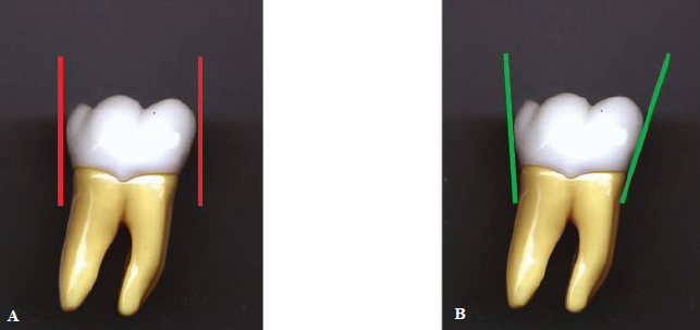 <p><span style="color: rgb(255, 0, 0);"><strong>A: Incorrect </strong></span></p><ul><li><p>Red lines — incorrect alignment to distal and mesial surfaces of mandibular molar</p></li></ul><p></p><p><span style="color: green;"><strong>B: Correct</strong></span></p><ul><li><p>Green lines — Correct alignment to distal and mesial surfaces of mandibular molar</p></li></ul><p></p>