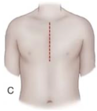 <p>Median Sternotomy</p>