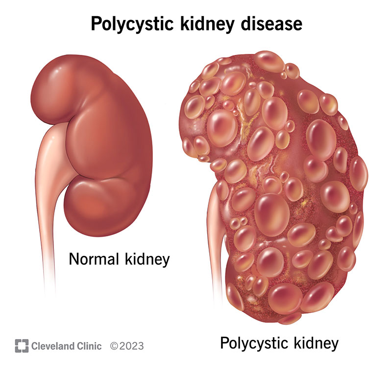 <p><span>Polycystic Kidney Disease (PKD)</span></p>
