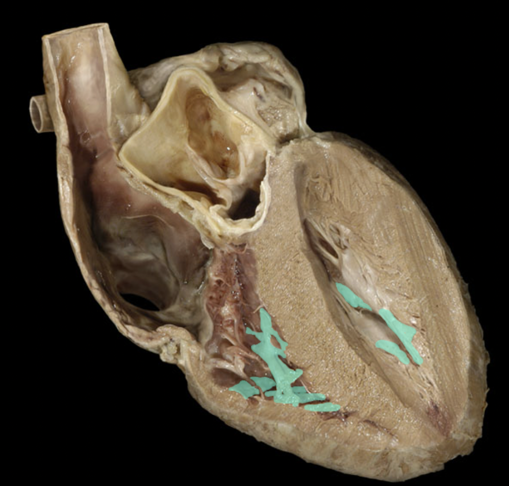 <p>Identify the feature of the right ventricle</p>