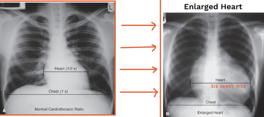 <p>The heart width should be less than half the chest width at the level of the diaphragm</p>