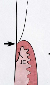 <p>stage of passive eruption: The most apical limit of the epithelial attachment is on the cementum, with the base of the sulcus at the cementoenamel junction</p>
