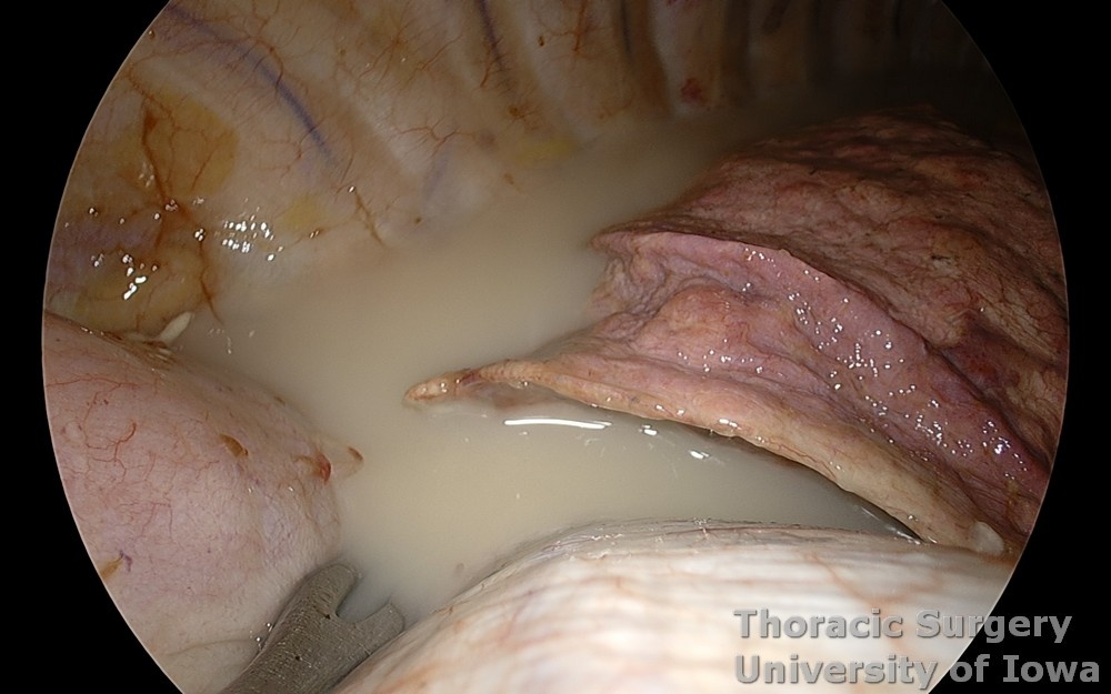<p>a condition where lymphatic fluid accumulates in the pleural cavity, often a complication in infants with congenital heart defects. It can result from surgical interventions or lymphatic obstruction. </p>