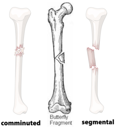 <p>Comminuted: 2+ fracture lines = Multiple bone fragments</p><ul><li><p>Butterfly Fragment: Triangle-shaped fragment</p></li></ul><p>Segmental: 2 fracture lines + bone fragment between proximal + distal bone portions</p>