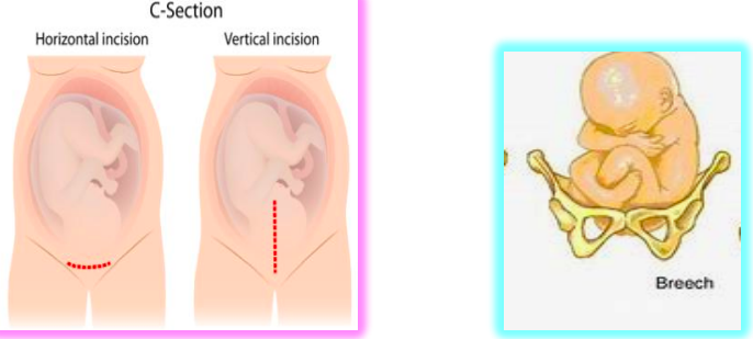 <p>placenta previa → c section</p><p>umbilical cord prolapse → need c section </p><p>abnormal fetal presentation → c section </p><p>high station of fetus → c section </p><p>active herpes → c section</p><p>abnormal structure of pelvis → c section</p><p>previous vertical c section → c section </p>