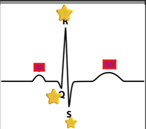 <p>What does the QRS complex represent?</p>