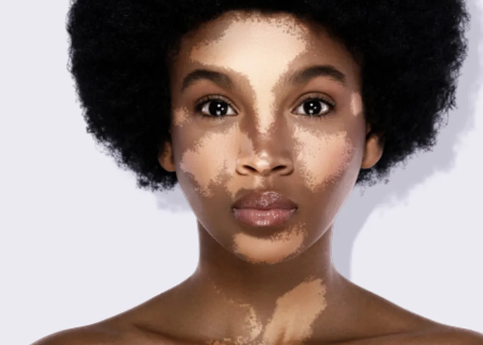 <p>Vitiligo</p>