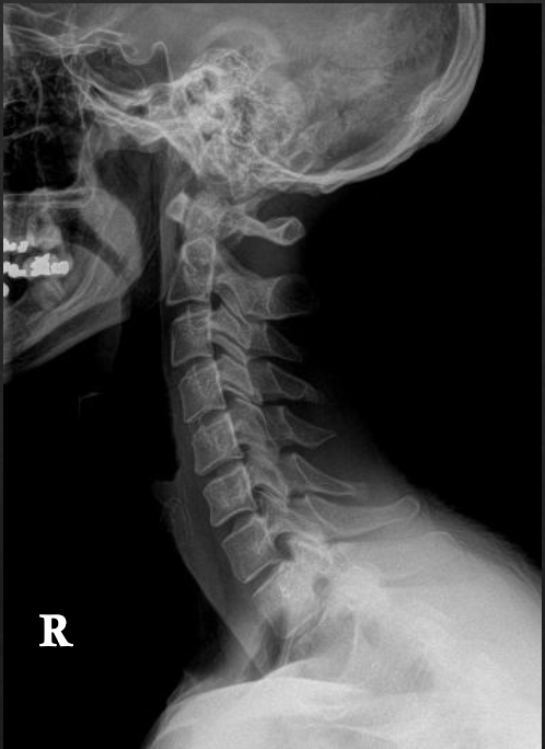 <p>Is this film of diagnostic quality (Lateral Cervical)</p>