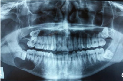 <p>A 25 year old patient present with mild swelling of lower jaw. Intra orally a small swelling was visible over right molar region. A radiograph taken. Provide diagnosis and justify</p>