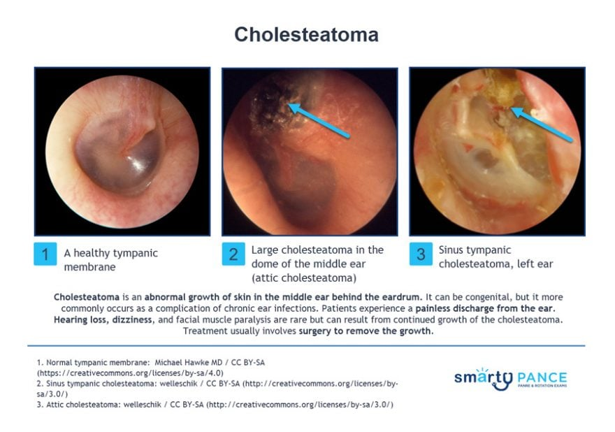 <p>Painless otorrhea, brown/yellow discharge with a strong odor due to chronic eustachian tube dysfunction, leading to chronic negative pressure that causes the formation of granulation tissue </p><p>-Presentation: granulation tissue and conductive hearing loss </p><p>-Dx: otoscopic visualization, CT and audiogram to evaluate hearing loss </p>