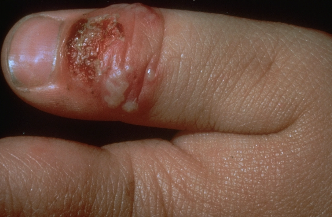 <p>Aandoening?</p>