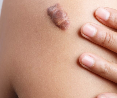 <p>elevated, rounded, and firm clawlike skin tags that extend beyond original site of injury, more common in dark skin</p>