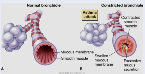 <p><span style="background-color: transparent;">asthma</span></p>
