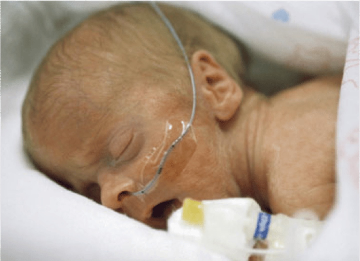 <p>- infants born <u><mark data-color="#f1ffcd" style="background-color: rgb(241, 255, 205); color: inherit;">before completing 37th week of gestation</mark></u>.</p>